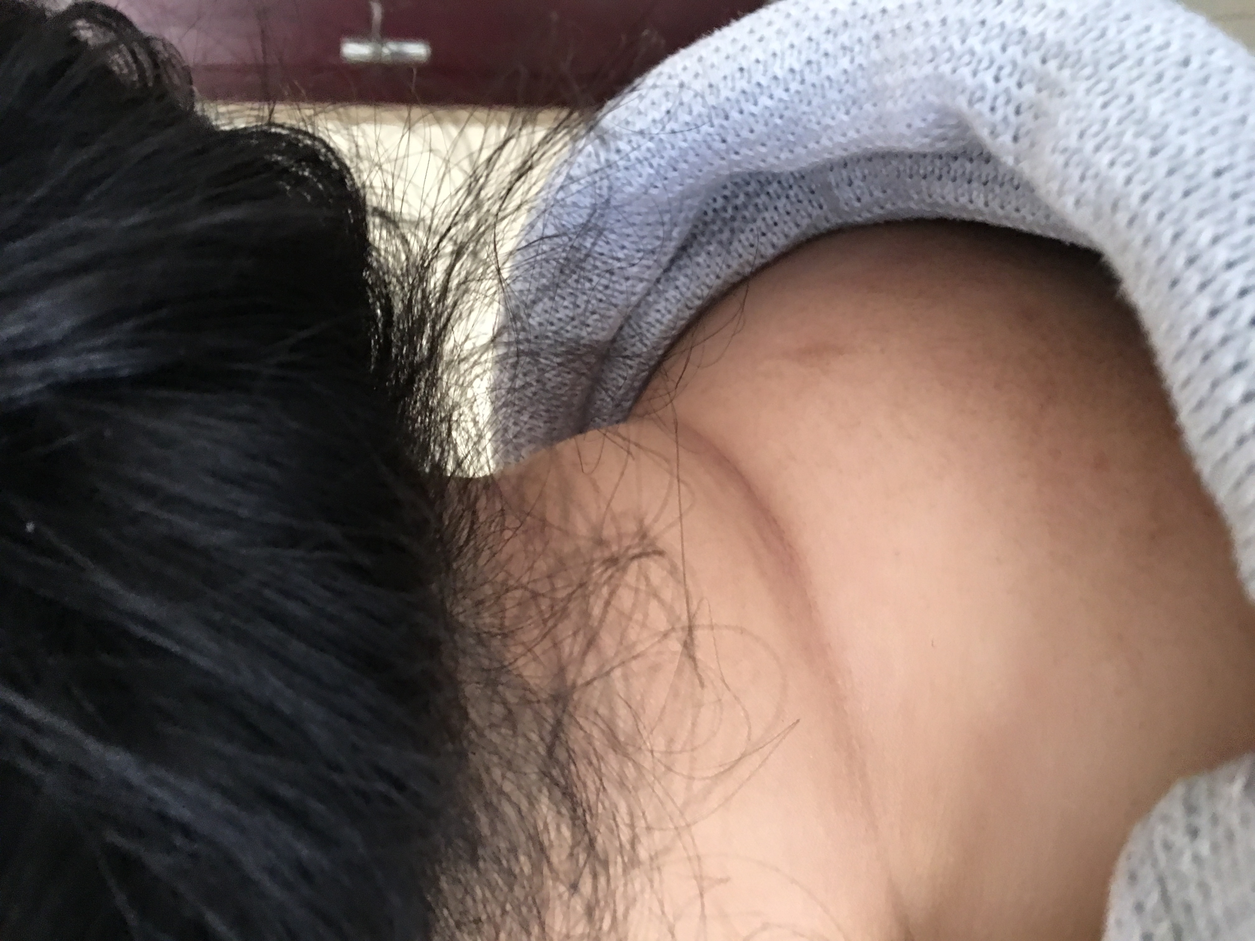 这个病例是颈椎富贵包调理前照片.jpg